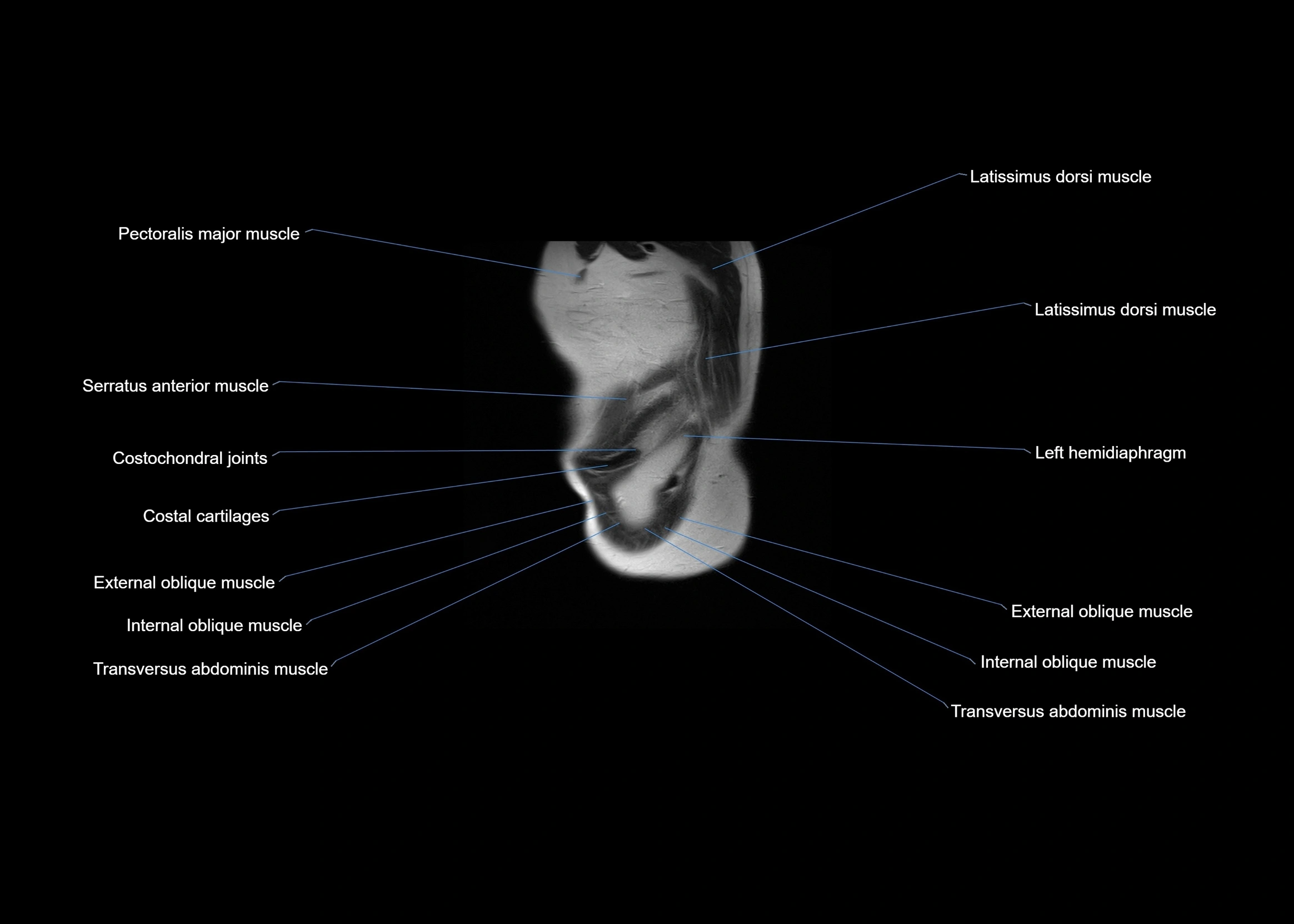 MRI abdomen sagittal cross sectional anatomy  radiology  image-img-00001-00066.webp